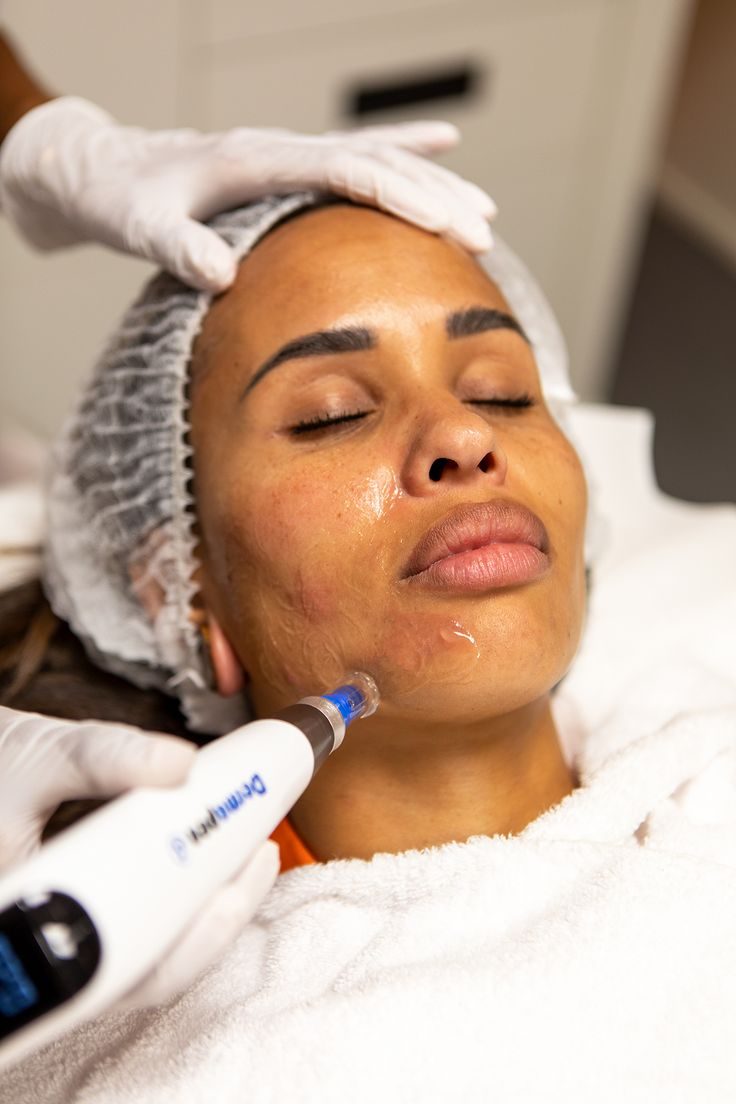 Microneedling with a targeted serum